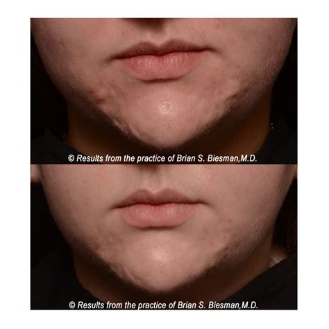 Scar Treatment Before And After Brian Biesman Md