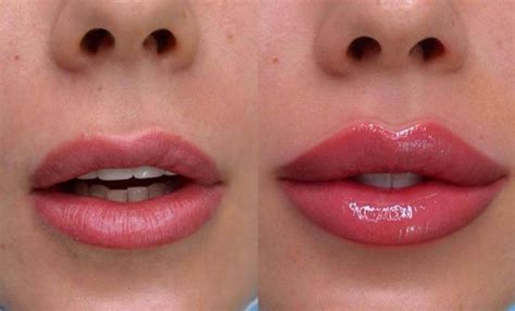 Russian Lip Filler Before And After Skinly Aesthetics
