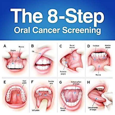 Beginning Of Mouth Cancer Find Out Oral Cancer Symptoms And Combat