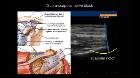 A New Nerve Block Procedure For The Suprascapular Nerve Based On A My