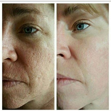 Amazing Results Using Neriumad For Enlarged Pores And Rough Skin Texture