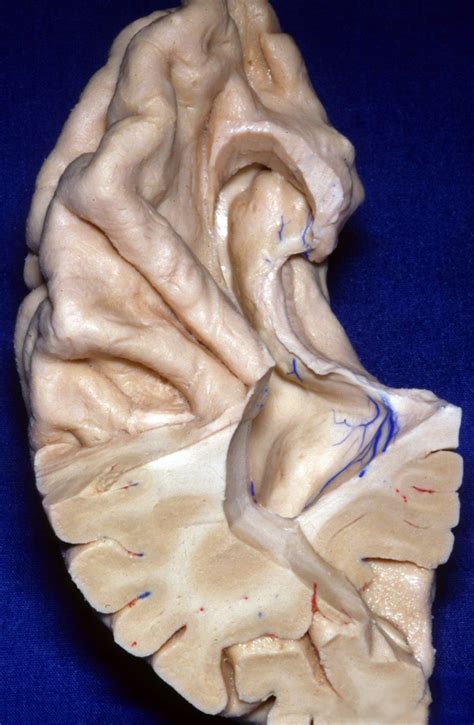 Superior Perspective Of The Temporal Lobe And Lateral Ventricle