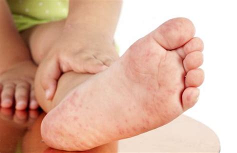 Causes And Treatments For Red Spots On Soles Of Feet