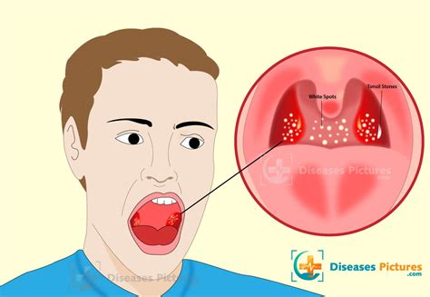 White Spots On Throat Tonsils Causes Symptoms Treatments Healthmd