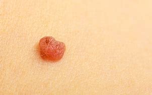 Show me a picture of the rashes for proper diagnosis and treatment. Get Rid of Skin Tags on Groin| Treatments | CoLaz