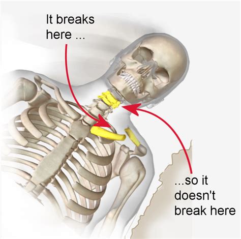 Collarbone Injuries In Volleyball Causes Symptoms And Treatment