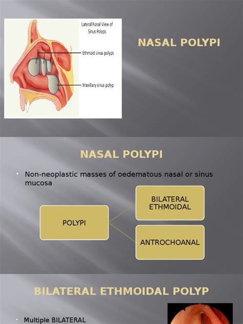 Nasal Polyp Pdf Rhinology Otorhinolaryngology