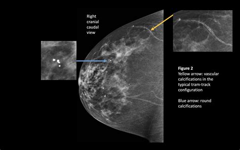 Benign Breast Calcifications Treatment Management Point Of Care