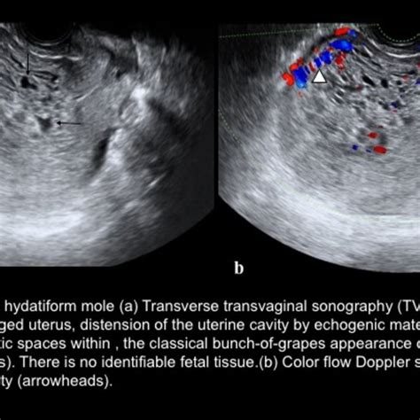 choriocarcinoma a transverse transvaginal sonography tvs image of download scientific