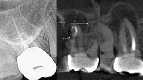 Periapical X Ray Cone Beam Ct Scan Cbct Lesion Of End