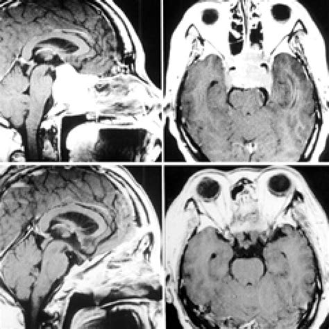 Case 3 Gadolinium Enhanced Mr Images Left Preoperative Sagittal