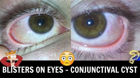 Bubbles On Your Eyeball • Conjunctival Chemosiscyst ♡ Youtube