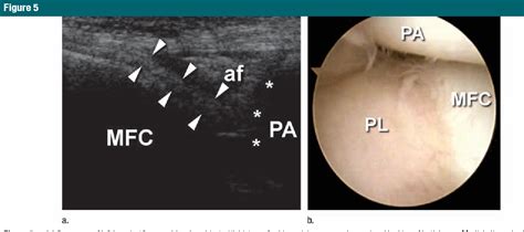 Figure 2 From Medial Plica Syndrome Of The Knee Diagnosis With Dynamic