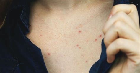 What You Need To Know About Chest Acne According To Top Dermatologists