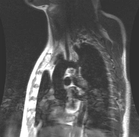 Coarctation Of Aorta Interesting Case Report Sumers Radiology Blog