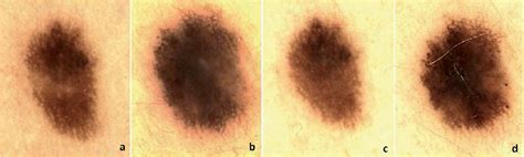 Familial Melanoma Associated With Li Fraumeni Syndrome And Atypical