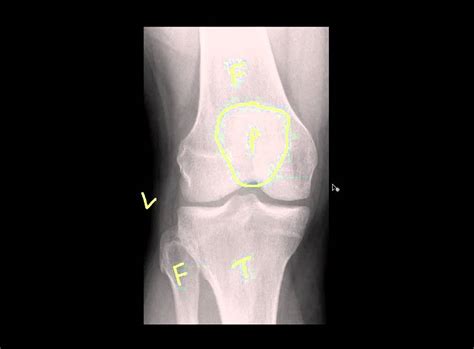 Part 1 Knee Radiographs For Trauma Mp4 YouTube