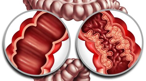 Crohn S Disease Causes Symptoms Diagnosis Treatment O