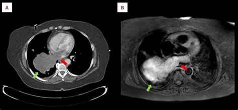 Ct Scan A And Mri B Of The Chest Showing A Pulmonary Vein And Left