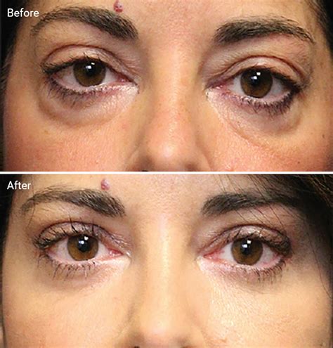 Laser Treatments For Dark Circles Are They Worth It Before And Afters Cost