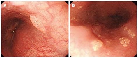 Using Typical Endoscopic Features To Diagnose Esophageal Squamous Papilloma