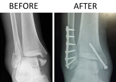 Success Story Trimalleolar Fracture Recovery Story — Restore Physical