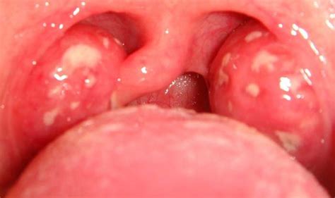 White Dots On The Tonsils Sore Tickle Throat Throat Cedag Media Tonsil