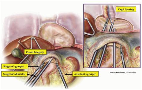 Repair Of Paraesophageal Hernia Thoracic Key