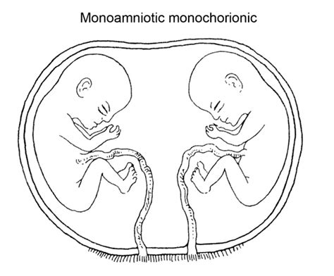 Types Of Twins Dizygotic Monozygotic Dichorionic And Monochorionic