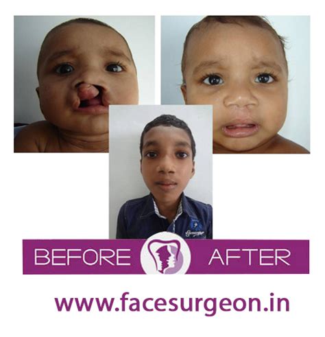 Cleft Lip And Cleft Palate Treatment In India Cleft Cosmetic Surgery