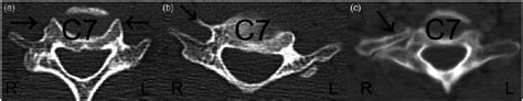 Ct Sections Of The C7 Transverse Processes Displaying A The Normal