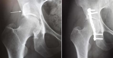 Acetabular Fractures Orthoinfo Aaos