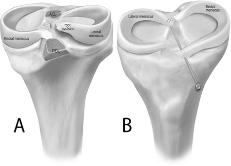 Figure From Altered Tibiofemoral Contact Mechanics Due To Lateral