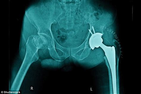 Lack Of Movement After Hip Replacements Leave Patients Unable To