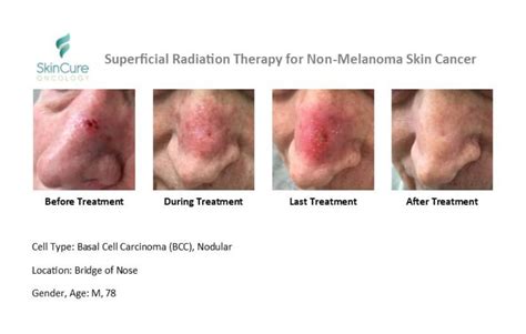 Announcing New Non Surgical Skin Cancer Treatment At Contour