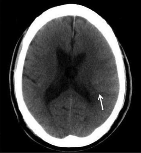 Non Contrast Brain Computed Tomography Showing Subarachnoid Hemorrhage