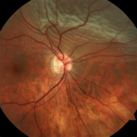 Retinal Detachment Retina Associates Of St Louis