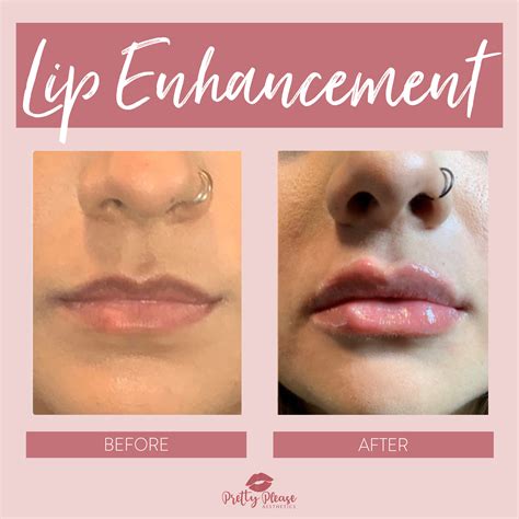 Pin On Before And After Lip Filler