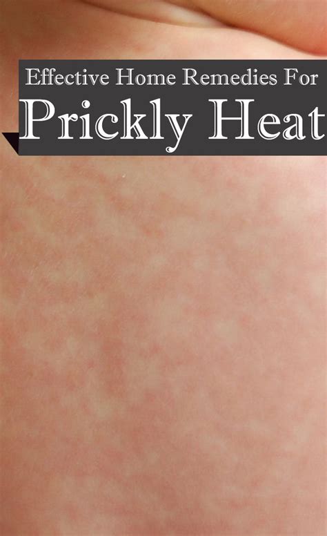 How To Get Rid Of Prickly Heat Heat Rash Heat Rash Prickly Heat Images And Photos Finder