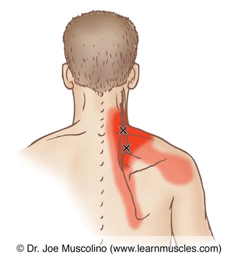 Levator Scapulae Trigger Points Learn Muscles