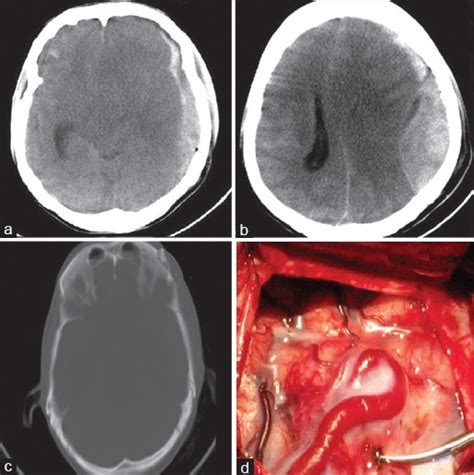 Patients with an acute subdural or epidural hematoma had a lower mortality and improved functional recovery when operated on ͻ2 h after onset of coma. Traumatic epidural and subdural hematomas and extensive ...