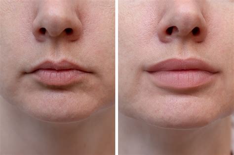 How Much Are Lip Fillers Metropolitan Skin Clinic
