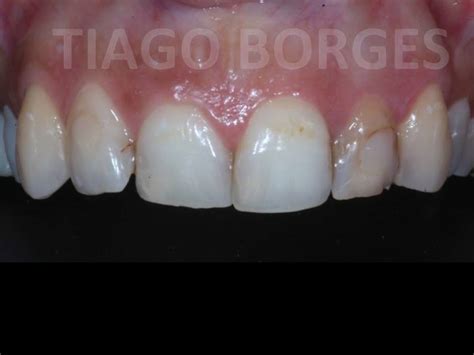 Coroas Cerâmicas Cmeb Advanced Oral Care Clinic