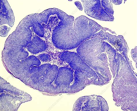 Genital Wart Light Micrograph Stock Image C0490640 Science