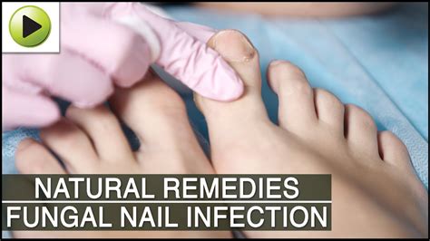 Home Remedies For Fungal Nail Infection Youtube
