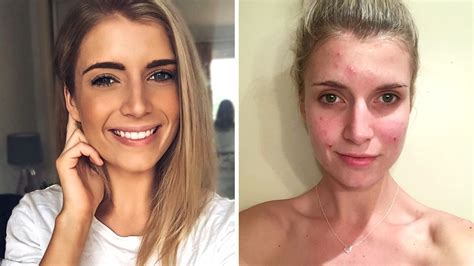 How To Hide Pimples Without Makeup Saubhaya Makeup