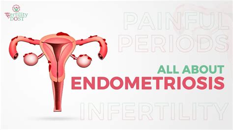 How To Get Pregnant With Endometriosis Youtube