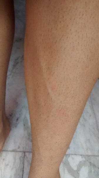 Why do my veins pop out? I got some veins popping out on my arms and legs due to ...