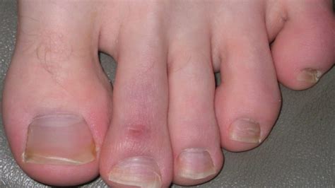 Chilblains What You Need To Know Patient Talk
