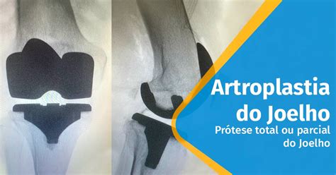 Artroplatia do Joelho Cirurgia de Prótese do joelho Dr Alexandre